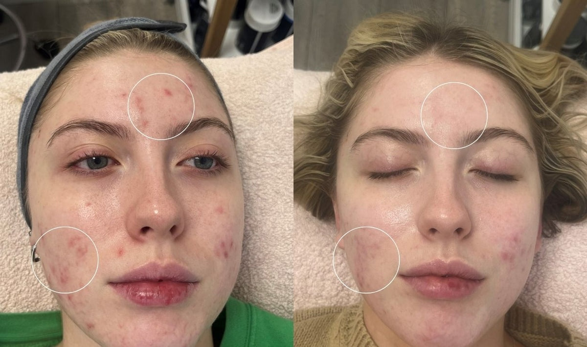Fewer blemishes and breakouts