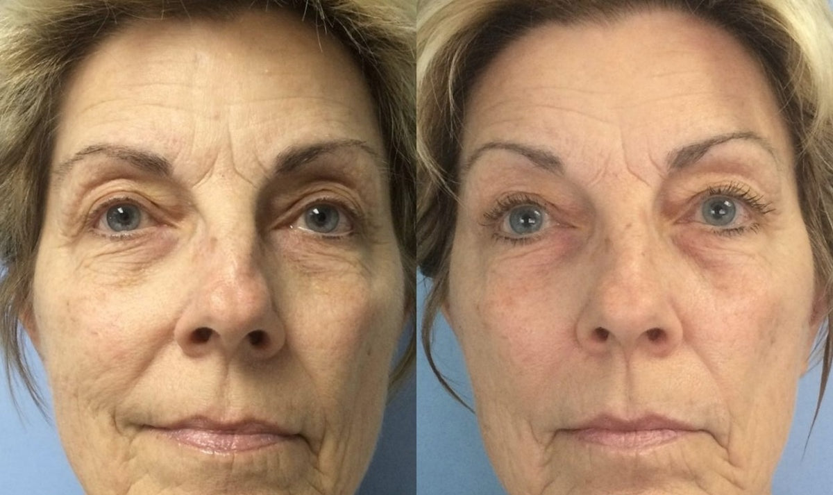 Softer lines, firmer skin